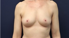 Breast Augmentation Before Photo by Laurence Glickman, MD, MSc, FRCS(c),  FACS; Garden City, NY - Case 38222