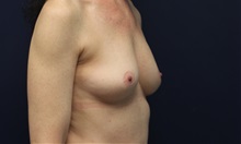 Breast Augmentation Before Photo by Laurence Glickman, MD, MSc, FRCS(c),  FACS; Garden City, NY - Case 38222