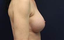 Breast Augmentation After Photo by Laurence Glickman, MD, MSc, FRCS(c),  FACS; Garden City, NY - Case 38222