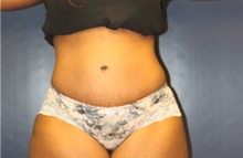 Tummy Tuck After Photo by Laurence Glickman, MD, MSc, FRCS(c),  FACS; Garden City, NY - Case 40800