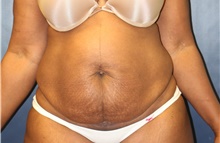 Tummy Tuck Before Photo by Laurence Glickman, MD, MSc, FRCS(c),  FACS; Garden City, NY - Case 40800