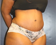 Tummy Tuck After Photo by Laurence Glickman, MD, MSc, FRCS(c),  FACS; Garden City, NY - Case 40800