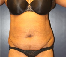 Tummy Tuck Before Photo by Laurence Glickman, MD, MSc, FRCS(c),  FACS; Garden City, NY - Case 40801