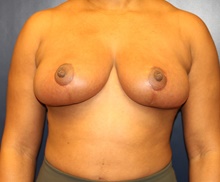 Breast Reduction After Photo by Laurence Glickman, MD, MSc, FRCS(c),  FACS; Garden City, NY - Case 40802