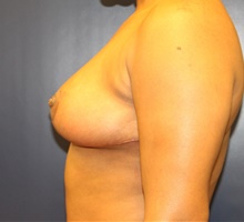 Breast Reduction After Photo by Laurence Glickman, MD, MSc, FRCS(c),  FACS; Garden City, NY - Case 40802
