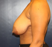 Breast Reduction Before Photo by Laurence Glickman, MD, MSc, FRCS(c),  FACS; Garden City, NY - Case 40802