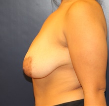 Breast Lift Before Photo by Laurence Glickman, MD, MSc, FRCS(c),  FACS; Garden City, NY - Case 40803