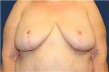 Breast Reduction After Photo by Laurence Glickman, MD, MSc, FRCS(c),  FACS; Garden City, NY - Case 40807