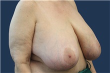 Breast Reduction Before Photo by Laurence Glickman, MD, MSc, FRCS(c),  FACS; Garden City, NY - Case 40807