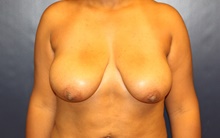 Breast Reduction Before Photo by Laurence Glickman, MD, MSc, FRCS(c),  FACS; Garden City, NY - Case 41405
