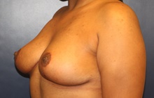 Breast Reduction After Photo by Laurence Glickman, MD, MSc, FRCS(c),  FACS; Garden City, NY - Case 41405