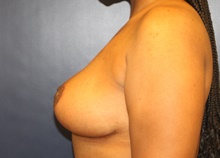 Breast Reduction After Photo by Laurence Glickman, MD, MSc, FRCS(c),  FACS; Garden City, NY - Case 41405