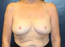 Breast Reduction After Photo by Laurence Glickman, MD, MSc, FRCS(c),  FACS; Garden City, NY - Case 41406