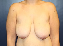 Breast Lift Before Photo by Laurence Glickman, MD, MSc, FRCS(c),  FACS; Garden City, NY - Case 41410