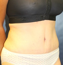 Tummy Tuck After Photo by Laurence Glickman, MD, MSc, FRCS(c),  FACS; Garden City, NY - Case 41411