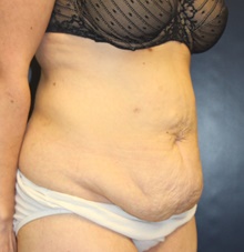 Tummy Tuck Before Photo by Laurence Glickman, MD, MSc, FRCS(c),  FACS; Garden City, NY - Case 41411