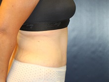 Tummy Tuck After Photo by Laurence Glickman, MD, MSc, FRCS(c),  FACS; Garden City, NY - Case 41411