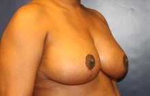 Breast Reduction After Photo by Laurence Glickman, MD, MSc, FRCS(c),  FACS; Garden City, NY - Case 41412