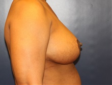Breast Reduction After Photo by Laurence Glickman, MD, MSc, FRCS(c),  FACS; Garden City, NY - Case 41412