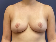 Breast Reduction After Photo by Laurence Glickman, MD, MSc, FRCS(c),  FACS; Garden City, NY - Case 41810