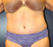 Tummy Tuck After Photo by Laurence Glickman, MD, MSc, FRCS(c),  FACS; Garden City, NY - Case 41812