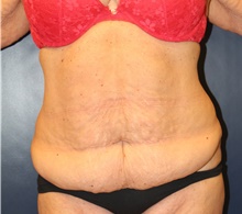 Tummy Tuck Before Photo by Laurence Glickman, MD, MSc, FRCS(c),  FACS; Garden City, NY - Case 41812