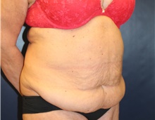 Tummy Tuck Before Photo by Laurence Glickman, MD, MSc, FRCS(c),  FACS; Garden City, NY - Case 41812