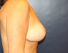 Breast Lift After Photo by Laurence Glickman, MD, MSc, FRCS(c),  FACS; Garden City, NY - Case 41813