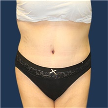 Tummy Tuck After Photo by Laurence Glickman, MD, MSc, FRCS(c),  FACS; Garden City, NY - Case 41815