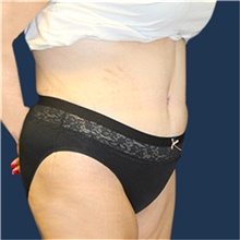 Tummy Tuck After Photo by Laurence Glickman, MD, MSc, FRCS(c),  FACS; Garden City, NY - Case 41815
