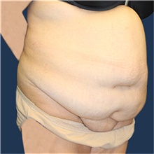 Tummy Tuck Before Photo by Laurence Glickman, MD, MSc, FRCS(c),  FACS; Garden City, NY - Case 41815