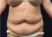 Tummy Tuck Before Photo by Laurence Glickman, MD, MSc, FRCS(c),  FACS; Garden City, NY - Case 41816