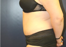 Tummy Tuck After Photo by Laurence Glickman, MD, MSc, FRCS(c),  FACS; Garden City, NY - Case 41816