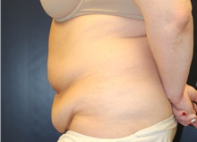 Tummy Tuck Before Photo by Laurence Glickman, MD, MSc, FRCS(c),  FACS; Garden City, NY - Case 41816