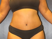 Tummy Tuck After Photo by Laurence Glickman, MD, MSc, FRCS(c),  FACS; Garden City, NY - Case 41817