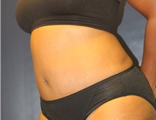 Tummy Tuck After Photo by Laurence Glickman, MD, MSc, FRCS(c),  FACS; Garden City, NY - Case 41817