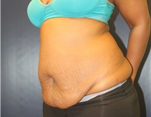 Tummy Tuck Before Photo by Laurence Glickman, MD, MSc, FRCS(c),  FACS; Garden City, NY - Case 41817