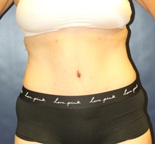 Tummy Tuck After Photo by Laurence Glickman, MD, MSc, FRCS(c),  FACS; Garden City, NY - Case 41822