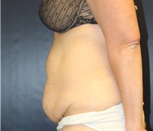 Tummy Tuck Before Photo by Laurence Glickman, MD, MSc, FRCS(c),  FACS; Garden City, NY - Case 41822