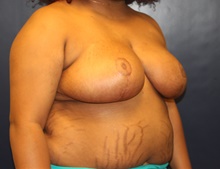 Breast Reduction After Photo by Laurence Glickman, MD, MSc, FRCS(c),  FACS; Garden City, NY - Case 41823