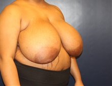 Breast Reduction Before Photo by Laurence Glickman, MD, MSc, FRCS(c),  FACS; Garden City, NY - Case 41823
