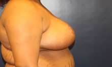 Breast Reduction After Photo by Laurence Glickman, MD, MSc, FRCS(c),  FACS; Garden City, NY - Case 41823