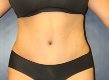 Tummy Tuck After Photo by Laurence Glickman, MD, MSc, FRCS(c),  FACS; Garden City, NY - Case 41824