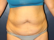 Tummy Tuck Before Photo by Laurence Glickman, MD, MSc, FRCS(c),  FACS; Garden City, NY - Case 41824