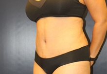 Tummy Tuck After Photo by Laurence Glickman, MD, MSc, FRCS(c),  FACS; Garden City, NY - Case 41824