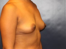 Breast Augmentation Before Photo by Laurence Glickman, MD, MSc, FRCS(c),  FACS; Garden City, NY - Case 41825