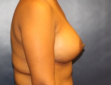Breast Augmentation After Photo by Laurence Glickman, MD, MSc, FRCS(c),  FACS; Garden City, NY - Case 41825