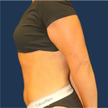 Tummy Tuck After Photo by Laurence Glickman, MD, MSc, FRCS(c),  FACS; Garden City, NY - Case 41828