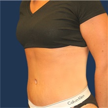 Tummy Tuck After Photo by Laurence Glickman, MD, MSc, FRCS(c),  FACS; Garden City, NY - Case 41828