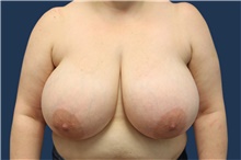 Breast Reduction Before Photo by Laurence Glickman, MD, MSc, FRCS(c),  FACS; Garden City, NY - Case 41829